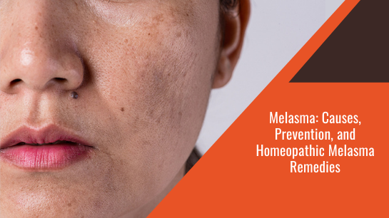 Melasma: Causes, Prevention, and Homeopathic Melasma Remedies